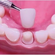 Dental crown